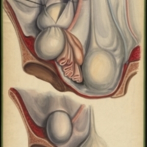 Teaching watercolor of two femoral hernias