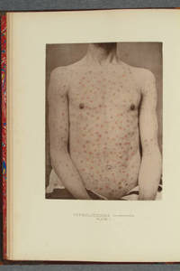 [Artotype plates in Photographic illustrations of cutaneous syphilis]