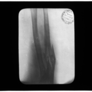X-ray of arm with broken bone in fore arm