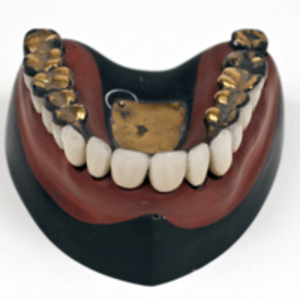 Superior denture/model with gold restorations