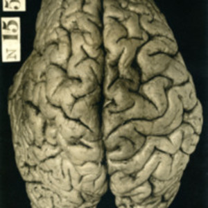 Brain of an alcoholic vagrant