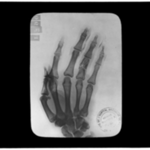 X-ray of hand with broken finger